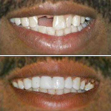 It is DESIGNED to look like a NATURAL SET OF TEETH.