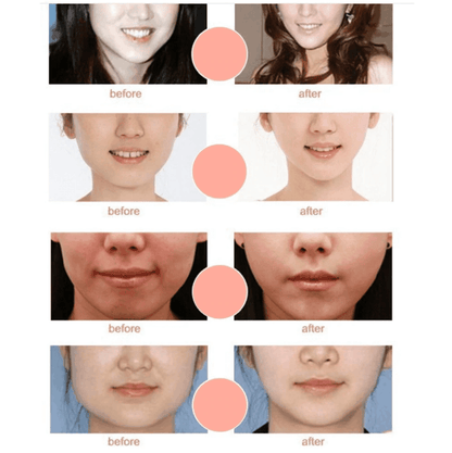 Ihrtrade Miracle V-Shaped Slimming Mask (2 Pieces/Set)